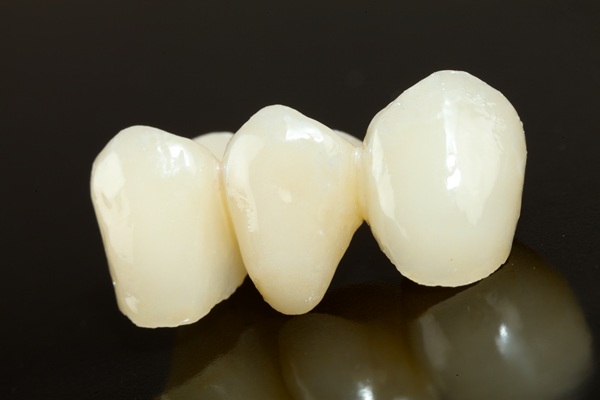 Why Dental Bridges Are Still A Smart Choice