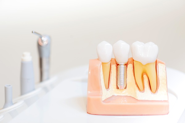 How Dental Implants Can Help Your Jawbone
