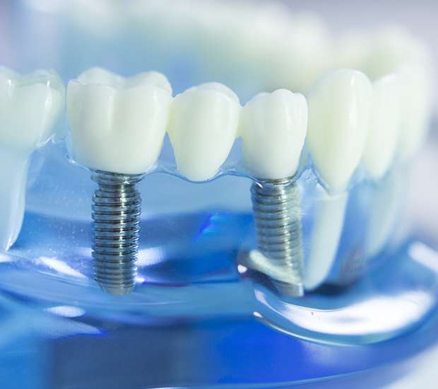 San Marcos Dental Implants