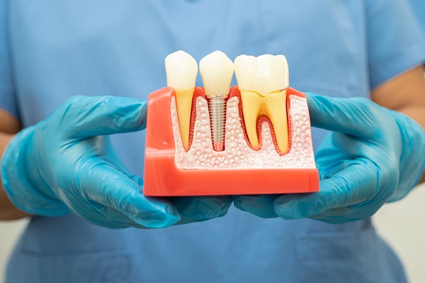 Three Signs You May Need A Root Canal