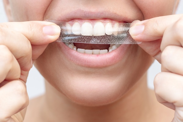 Can Teeth Whitening Products Be Used On Veneers?