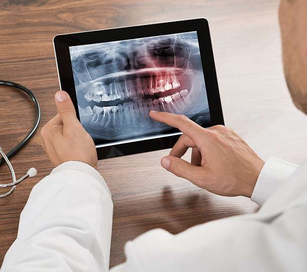 San Marcos Types of Dental Root Fractures